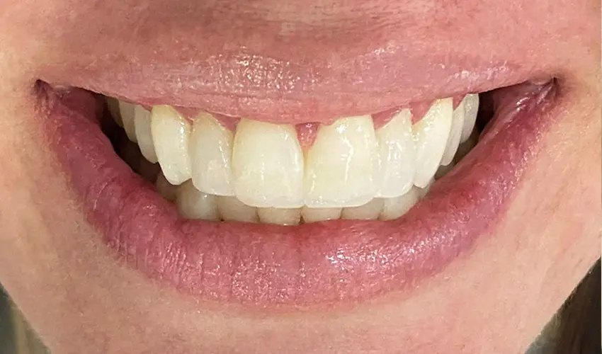 After dental veneers transformation Las Vegas patient 2